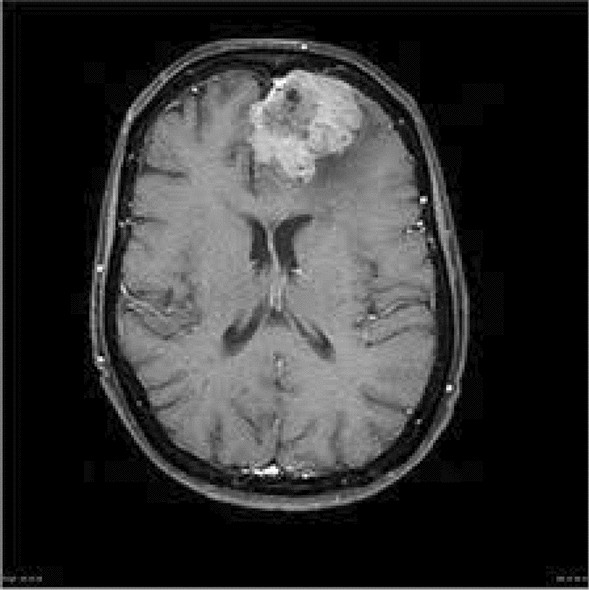 Brain Tumor Detection