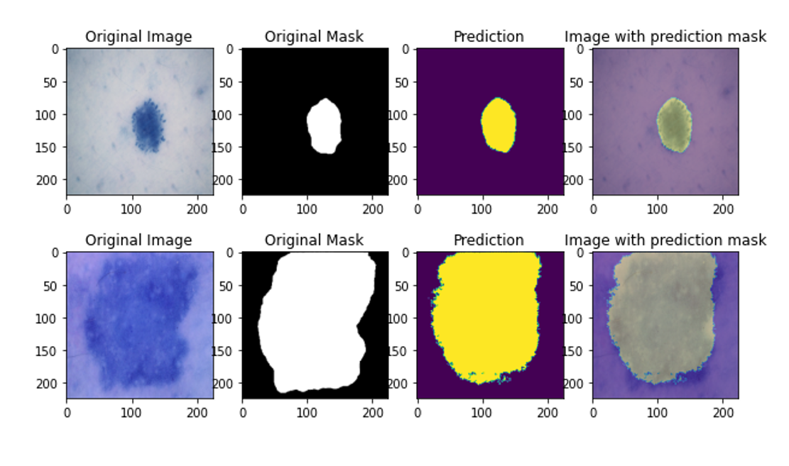 Skin Cancer Segmentation